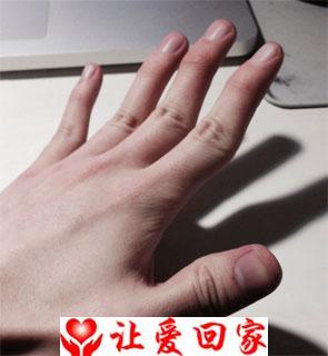 家族手指特殊弯曲，嘉兴女孤儿